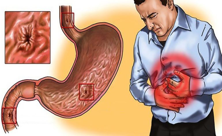 Cum să tratezi eficient gastrita: Ghid complet de medicamente, dietă și stil de viață